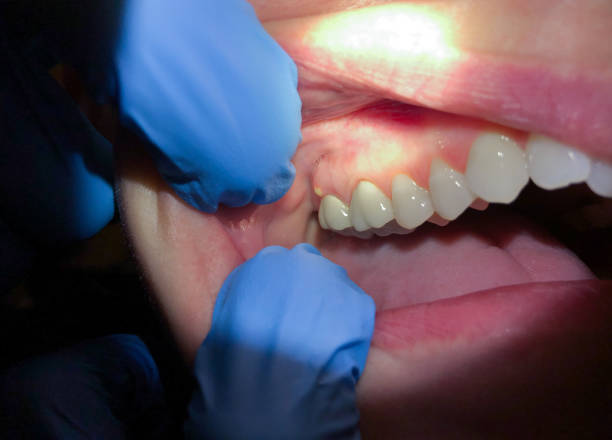 Best Knocked-Out Tooth (Avulsed Tooth) Treatment in Parsons, WV